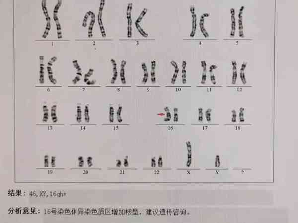 染色体16号异常能不能要孩子看过来，权衡利弊就有答案